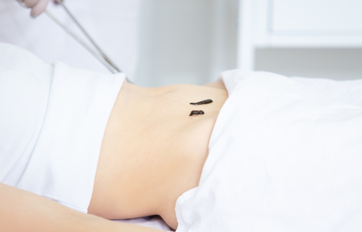 Sülük Tedavisi Sülük Tedavisi